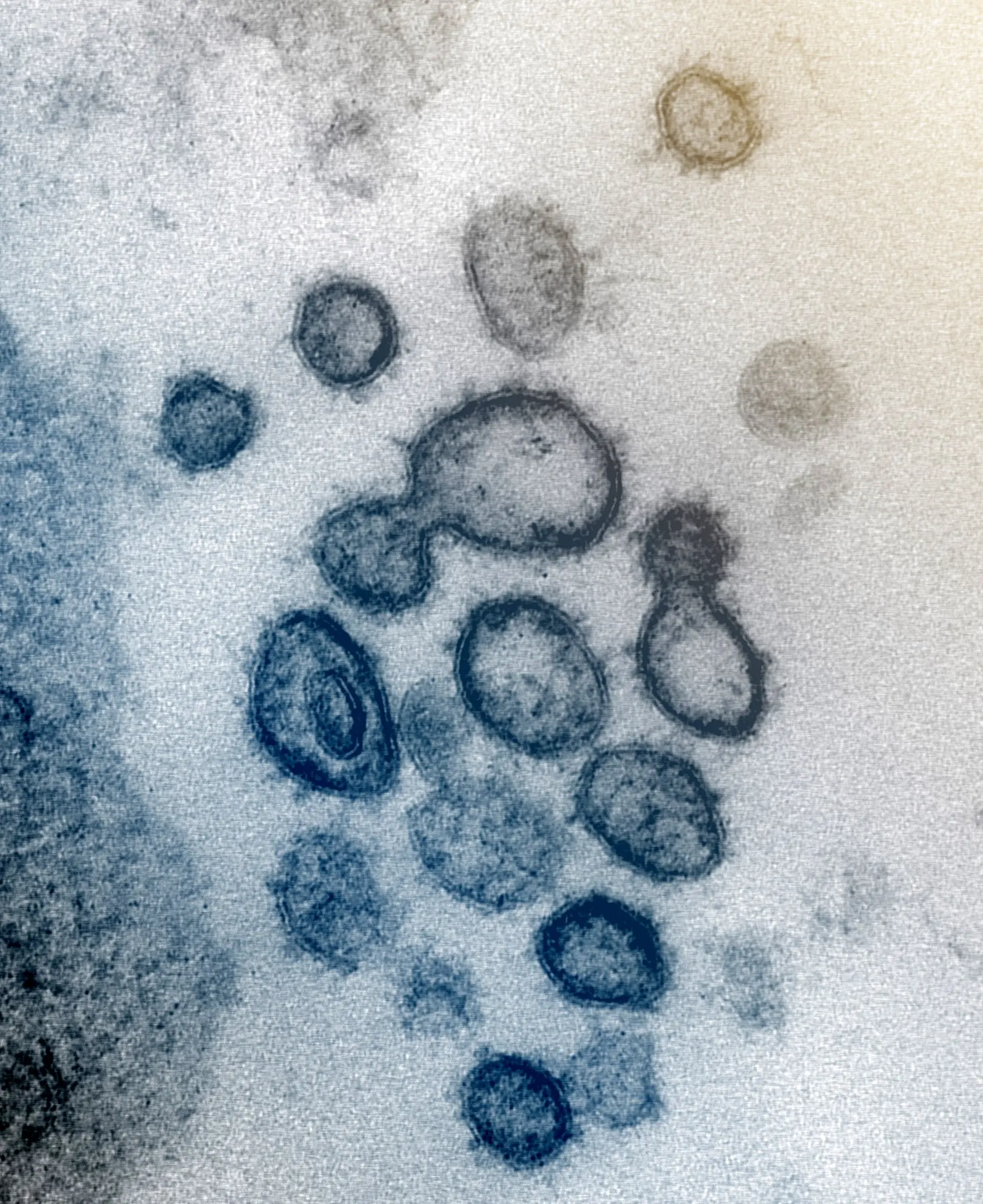 电子显微镜下的新冠病毒（SARS-CoV-2）真实影像_荒原之梦